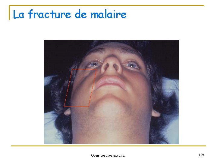 La fracture de malaire Cours destinés aux IFSI 129 