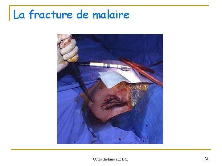 La fracture de malaire Cours destinés aux IFSI 131 