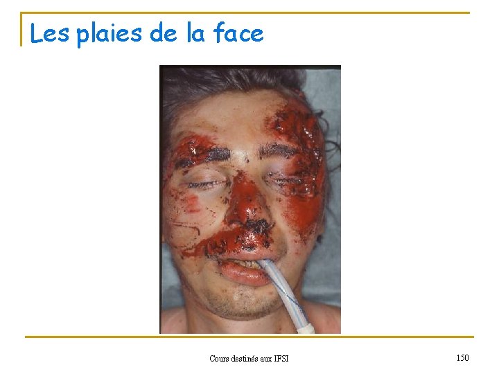 Les plaies de la face Cours destinés aux IFSI 150 