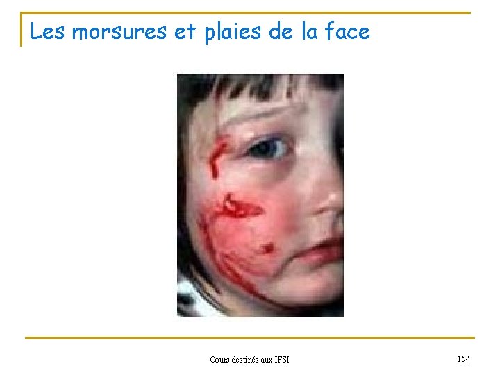 Les morsures et plaies de la face Cours destinés aux IFSI 154 