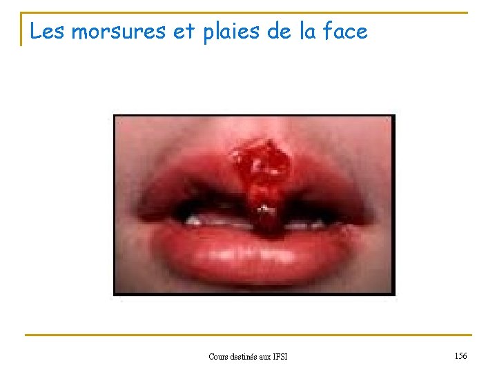 Les morsures et plaies de la face Cours destinés aux IFSI 156 