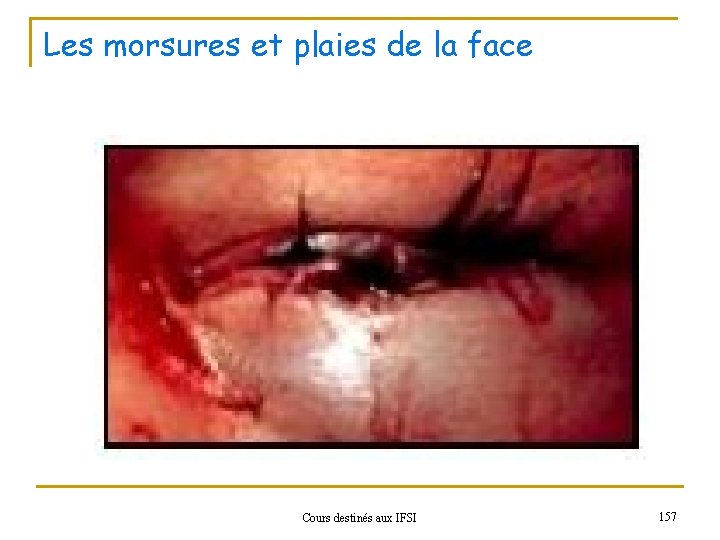 Les morsures et plaies de la face Cours destinés aux IFSI 157 