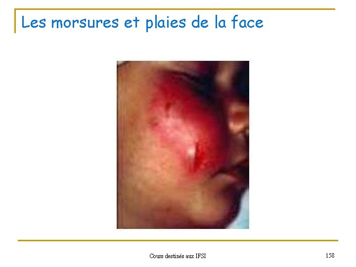 Les morsures et plaies de la face Cours destinés aux IFSI 158 