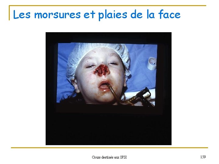 Les morsures et plaies de la face Cours destinés aux IFSI 159 