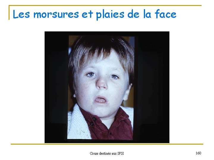 Les morsures et plaies de la face Cours destinés aux IFSI 160 