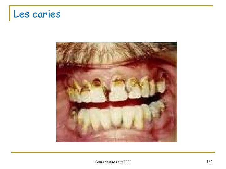 Les caries Cours destinés aux IFSI 162 