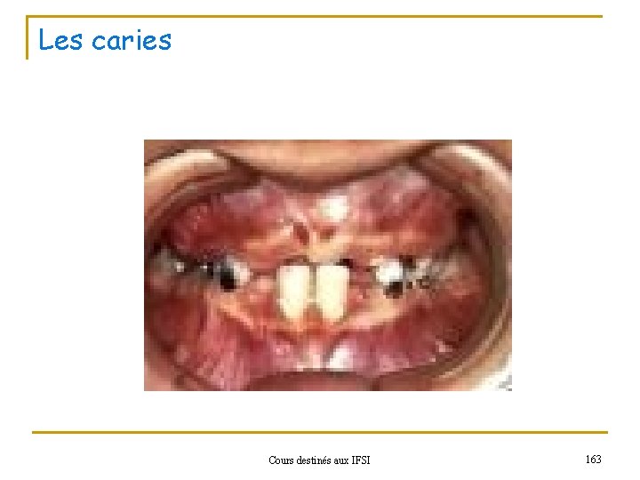 Les caries Cours destinés aux IFSI 163 