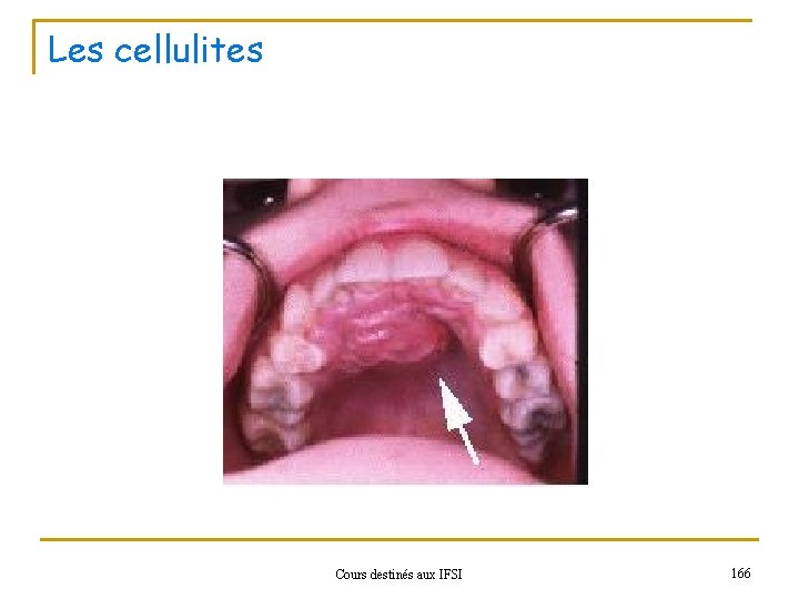 Les cellulites Cours destinés aux IFSI 166 