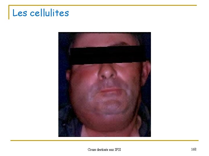 Les cellulites Cours destinés aux IFSI 168 
