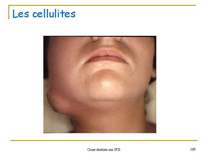 Les cellulites Cours destinés aux IFSI 169 