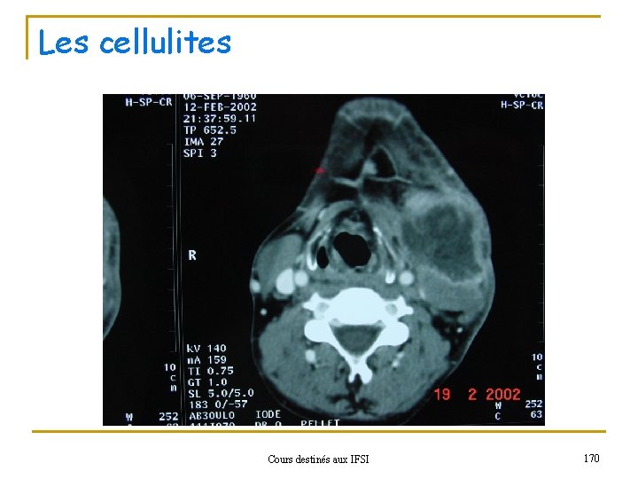 Les cellulites Cours destinés aux IFSI 170 