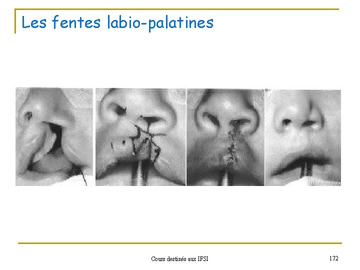 Les fentes labio-palatines Cours destinés aux IFSI 172 