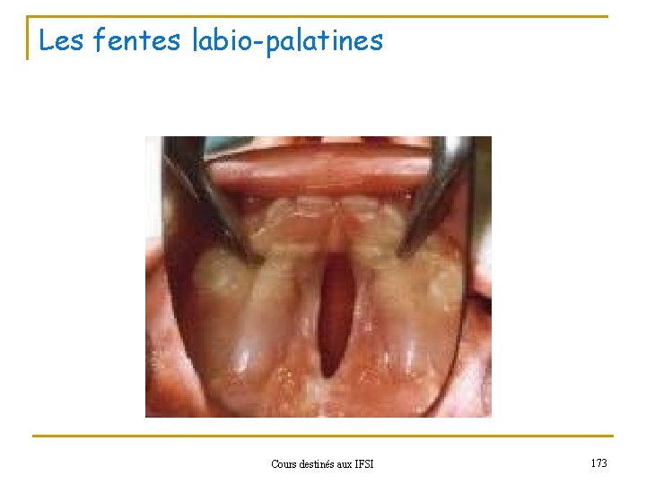 Les fentes labio-palatines Cours destinés aux IFSI 173 