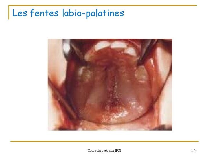 Les fentes labio-palatines Cours destinés aux IFSI 174 