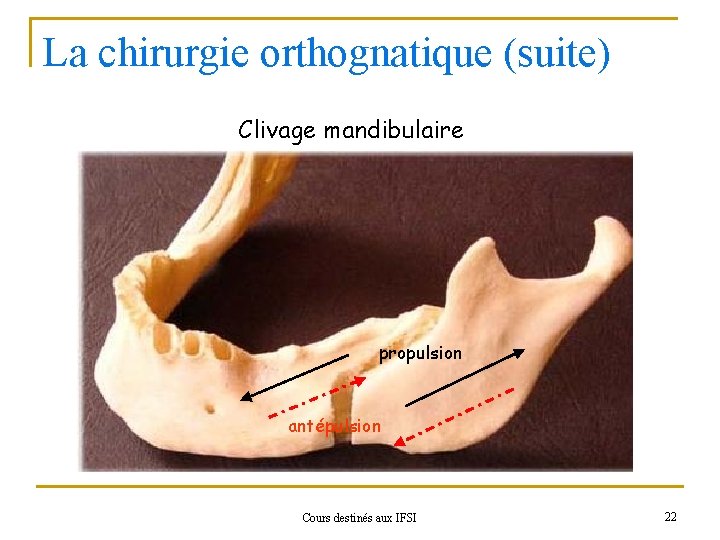 La chirurgie orthognatique (suite) Clivage mandibulaire propulsion antépulsion Cours destinés aux IFSI 22 