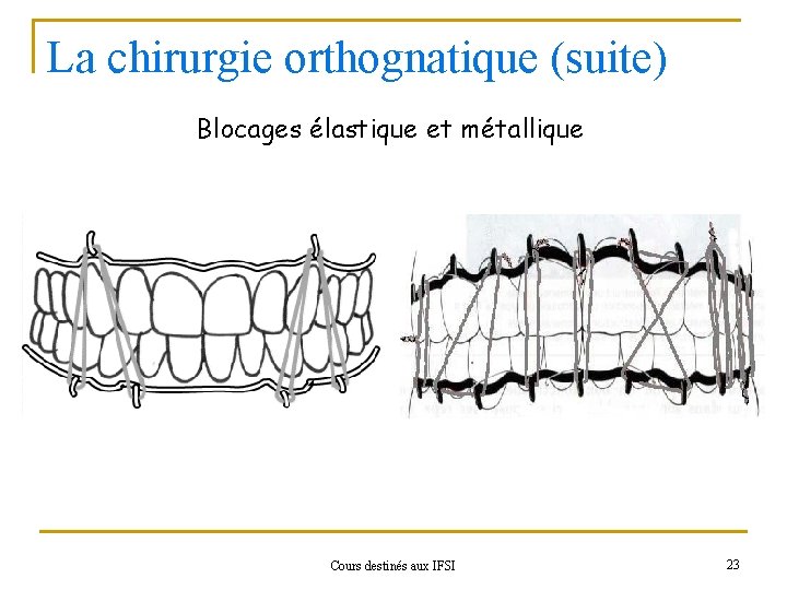 La chirurgie orthognatique (suite) Blocages élastique et métallique Cours destinés aux IFSI 23 