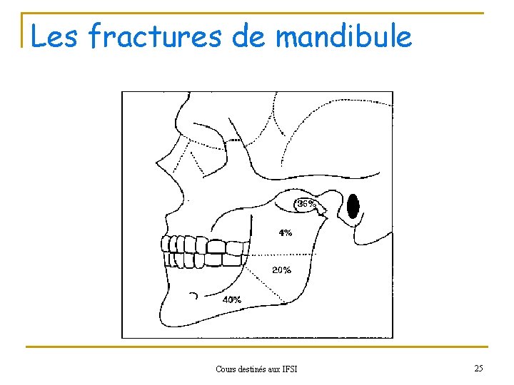 Les fractures de mandibule Cours destinés aux IFSI 25 