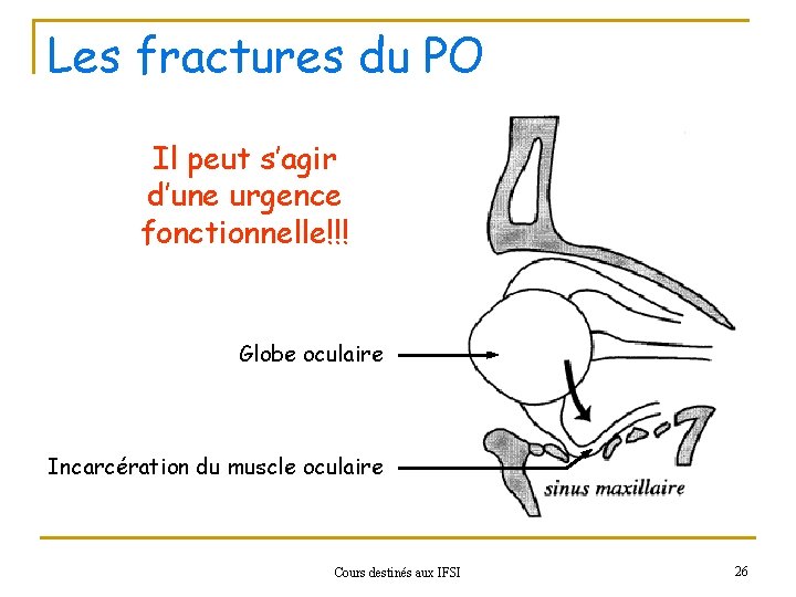 Les fractures du PO Il peut s’agir d’une urgence fonctionnelle!!! Globe oculaire Incarcération du