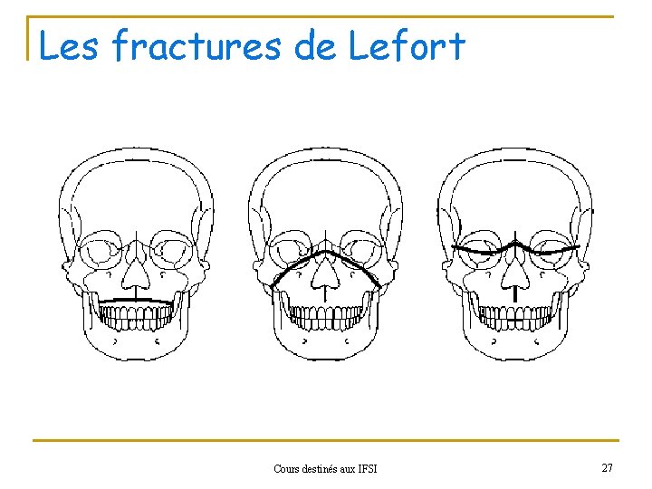 Les fractures de Lefort Cours destinés aux IFSI 27 