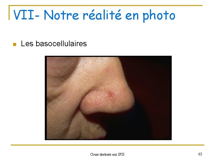 VII- Notre réalité en photo n Les basocellulaires Cours destinés aux IFSI 63 