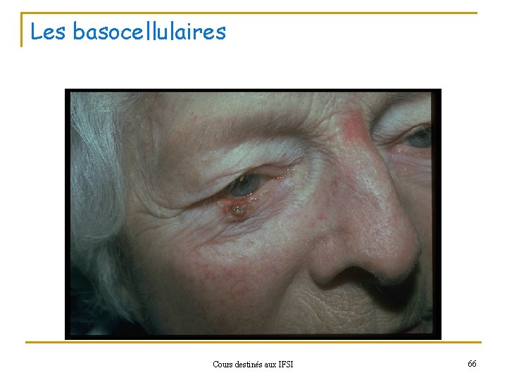 Les basocellulaires Cours destinés aux IFSI 66 