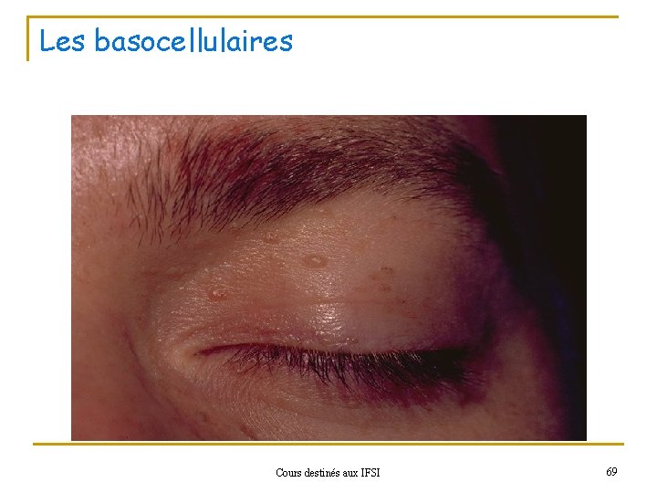 Les basocellulaires Cours destinés aux IFSI 69 