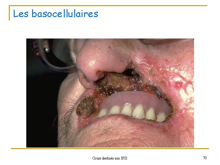 Les basocellulaires Cours destinés aux IFSI 70 
