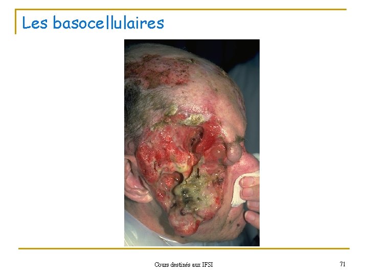 Les basocellulaires Cours destinés aux IFSI 71 