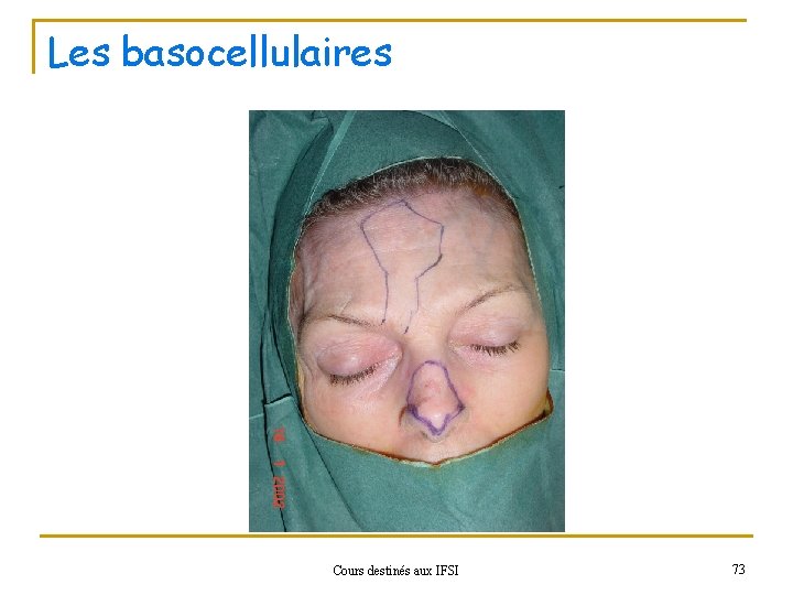 Les basocellulaires Cours destinés aux IFSI 73 
