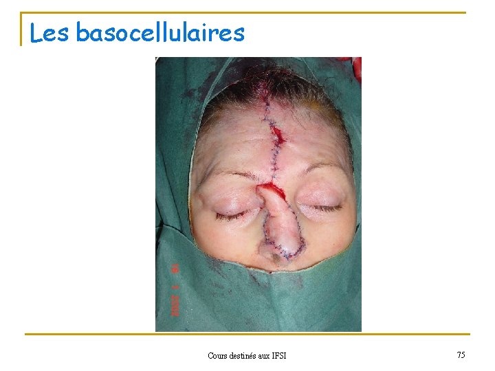 Les basocellulaires Cours destinés aux IFSI 75 