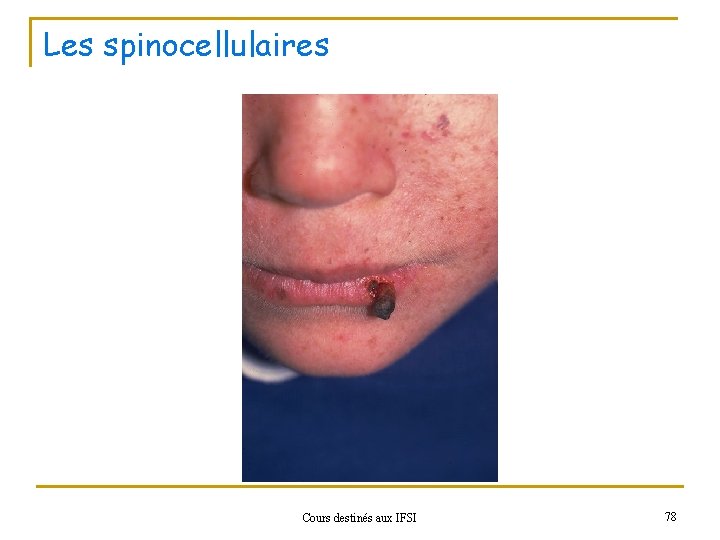 Les spinocellulaires Cours destinés aux IFSI 78 