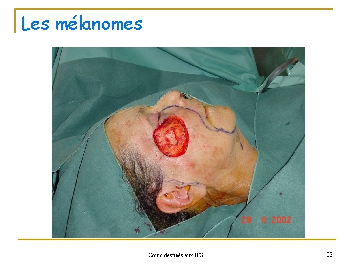 Les mélanomes Cours destinés aux IFSI 83 