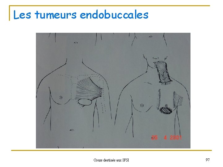 Les tumeurs endobuccales Cours destinés aux IFSI 97 