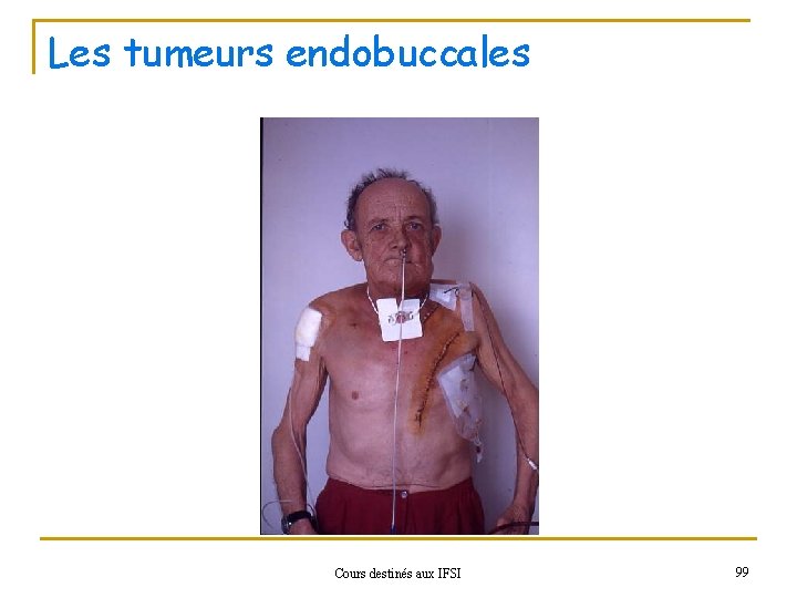 Les tumeurs endobuccales Cours destinés aux IFSI 99 