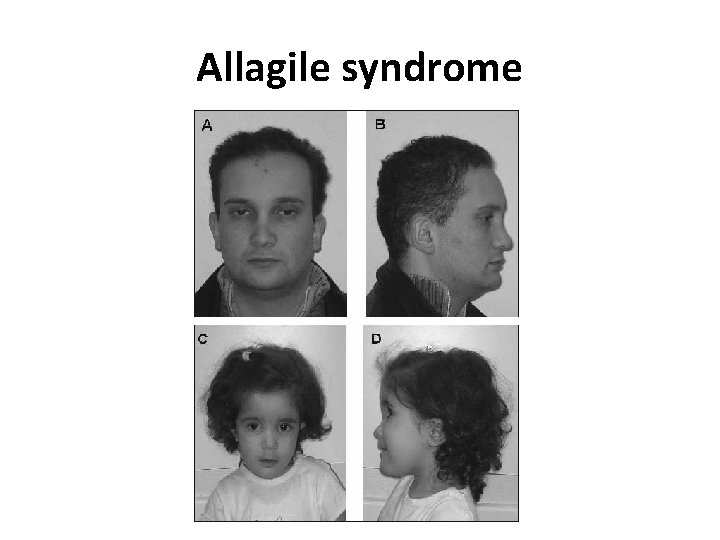 Allagile syndrome 