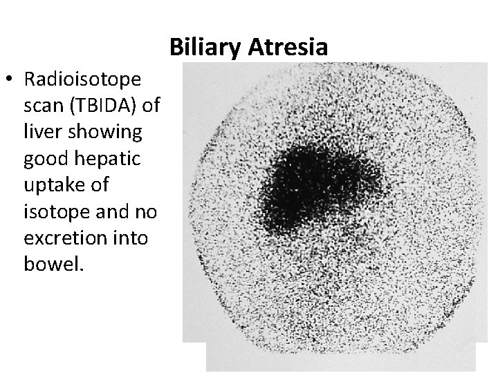 Biliary Atresia • Radioisotope scan (TBIDA) of liver showing good hepatic uptake of isotope