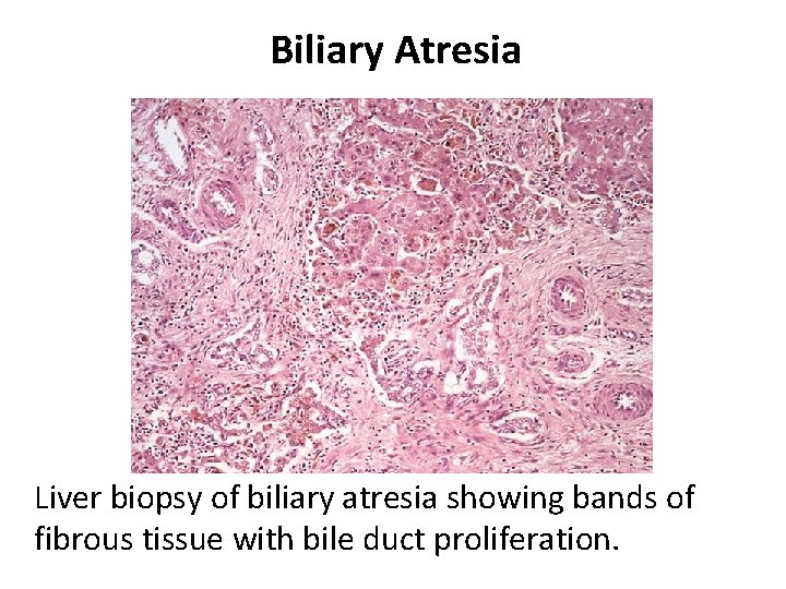 Biliary Atresia Liver biopsy of biliary atresia showing bands of fibrous tissue with bile