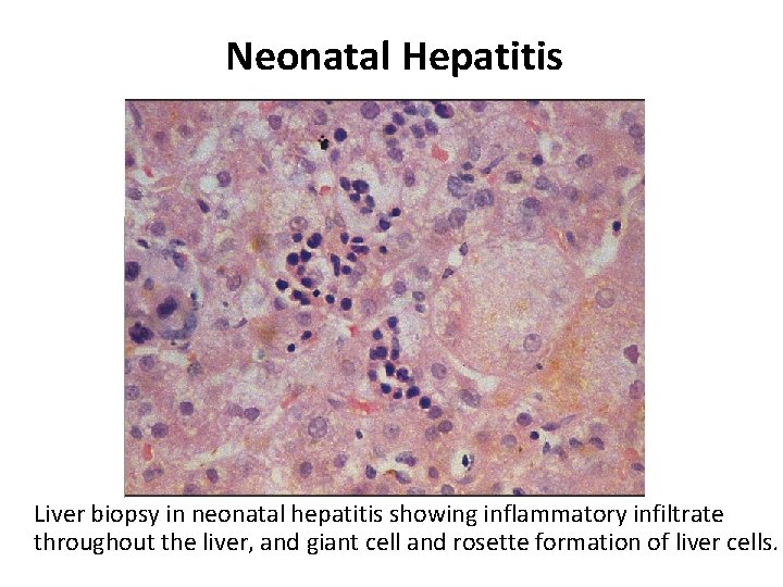 Neonatal Hepatitis Liver biopsy in neonatal hepatitis showing inflammatory infiltrate throughout the liver, and