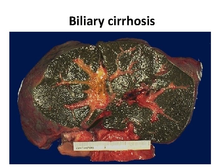 Biliary cirrhosis 