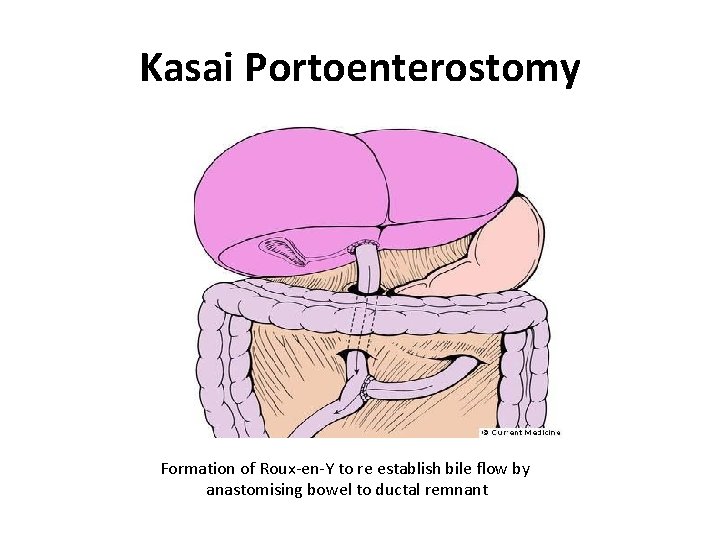 Kasai Portoenterostomy Formation of Roux-en-Y to re establish bile flow by anastomising bowel to