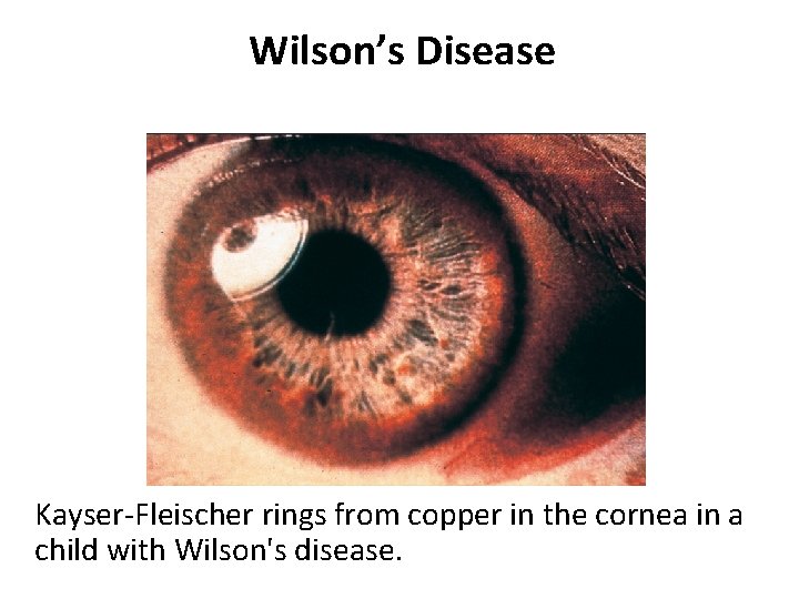 Wilson’s Disease Kayser-Fleischer rings from copper in the cornea in a child with Wilson's