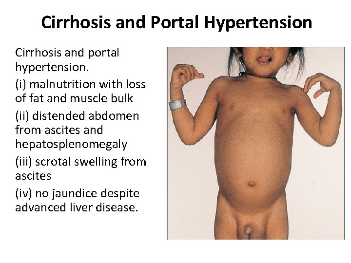 Cirrhosis and Portal Hypertension Cirrhosis and portal hypertension. (i) malnutrition with loss of fat