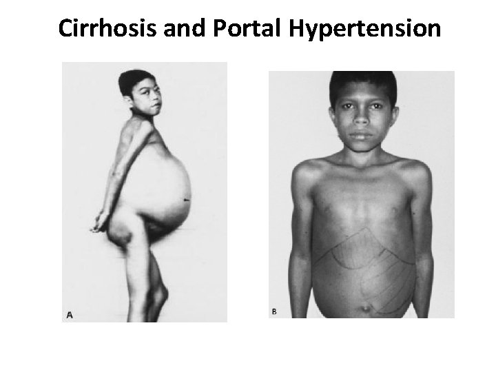 Cirrhosis and Portal Hypertension 