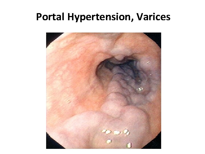 Portal Hypertension, Varices 