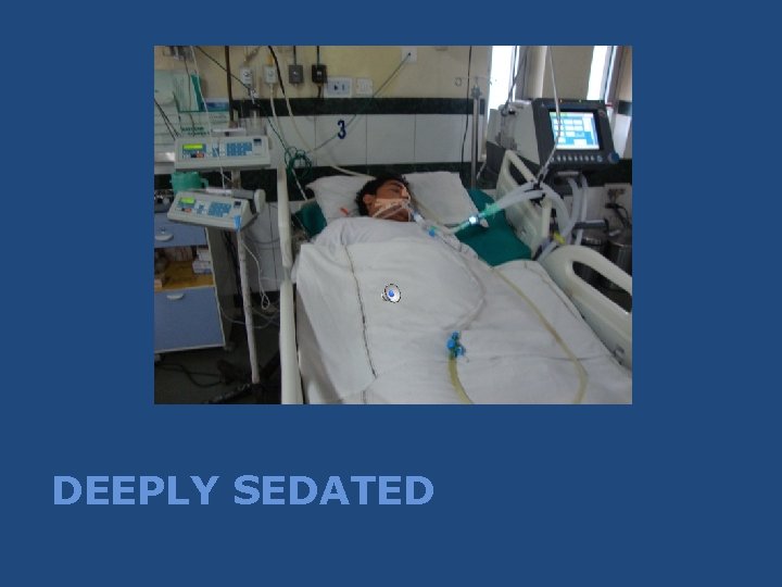 DEEPLY SEDATED DEEPLY SEDATED