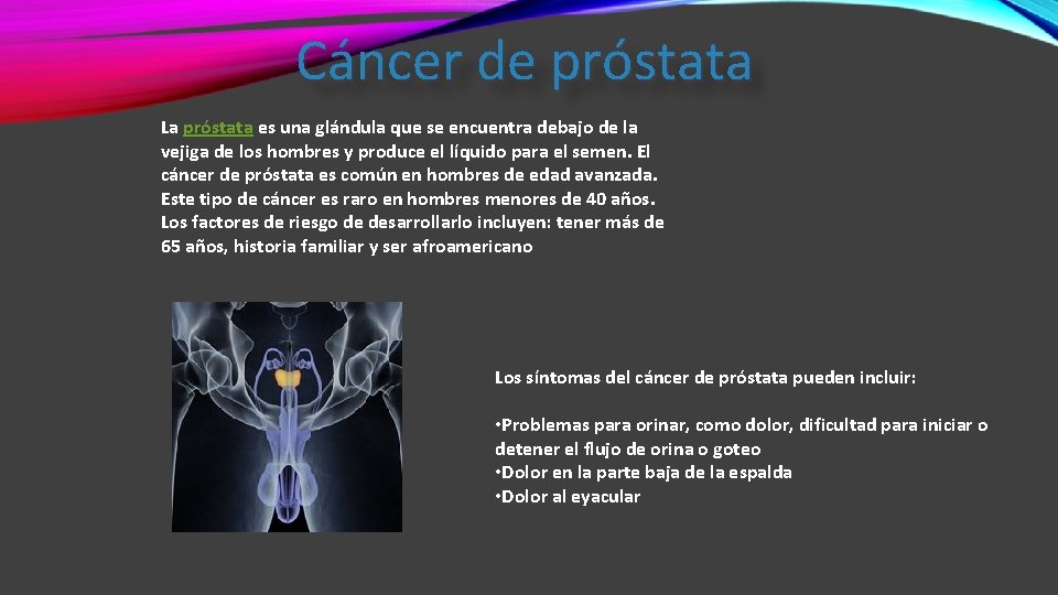 Cáncer de próstata La próstata es una glándula que se encuentra debajo de la