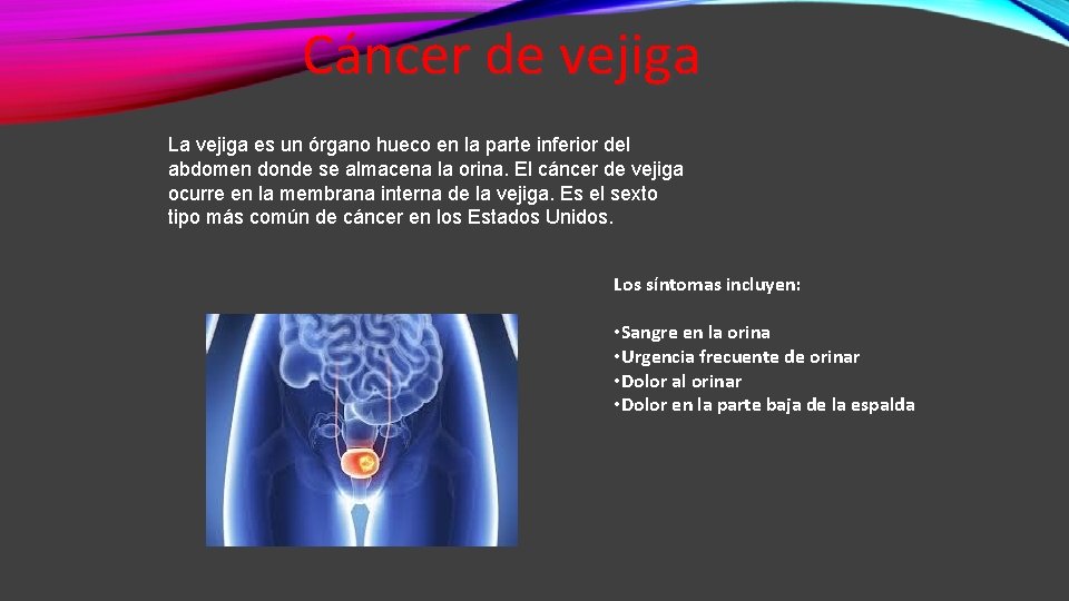 Cáncer de vejiga La vejiga es un órgano hueco en la parte inferior del