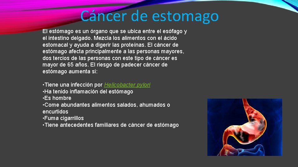 Cáncer de estomago El estómago es un órgano que se ubica entre el esófago