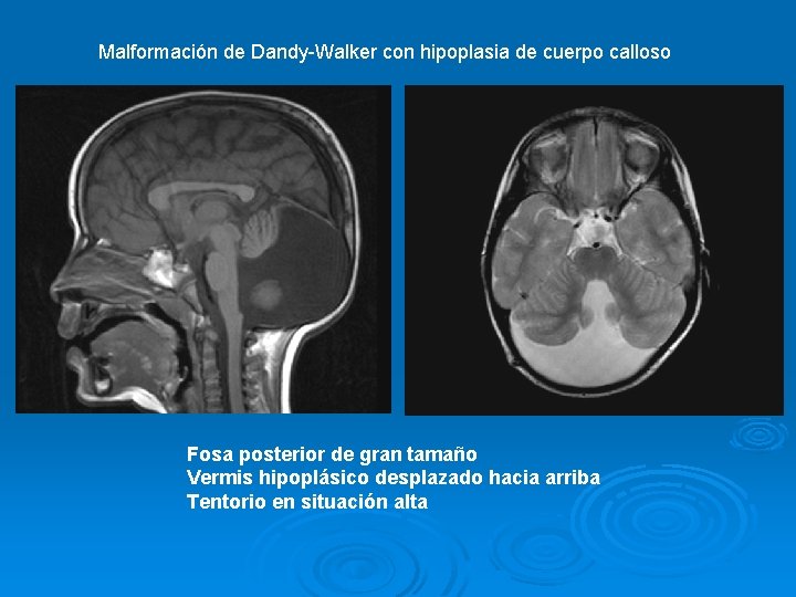 Malformación de Dandy-Walker con hipoplasia de cuerpo calloso Fosa posterior de gran tamaño Vermis