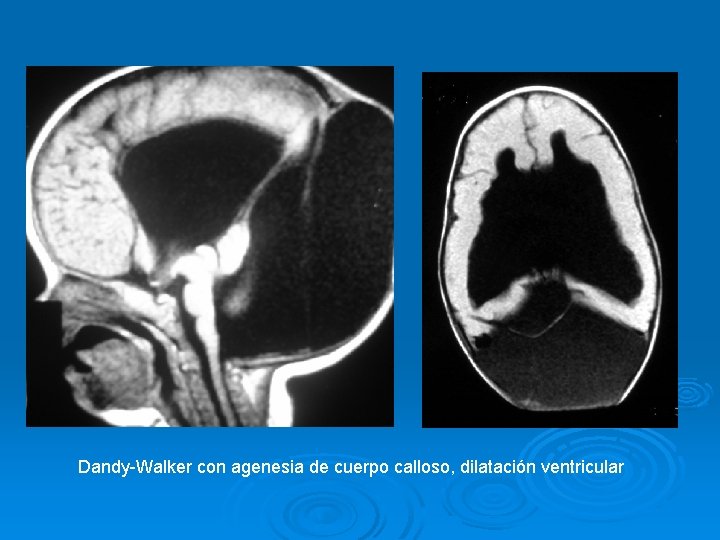 Dandy-Walker con agenesia de cuerpo calloso, dilatación ventricular 